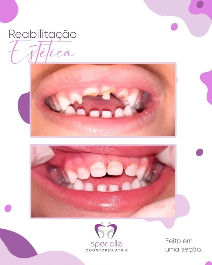 Reabilitação Estética